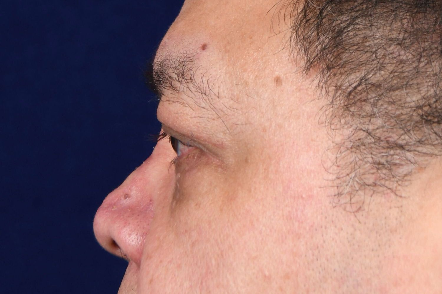 Lower Blepharoplasty Before & After