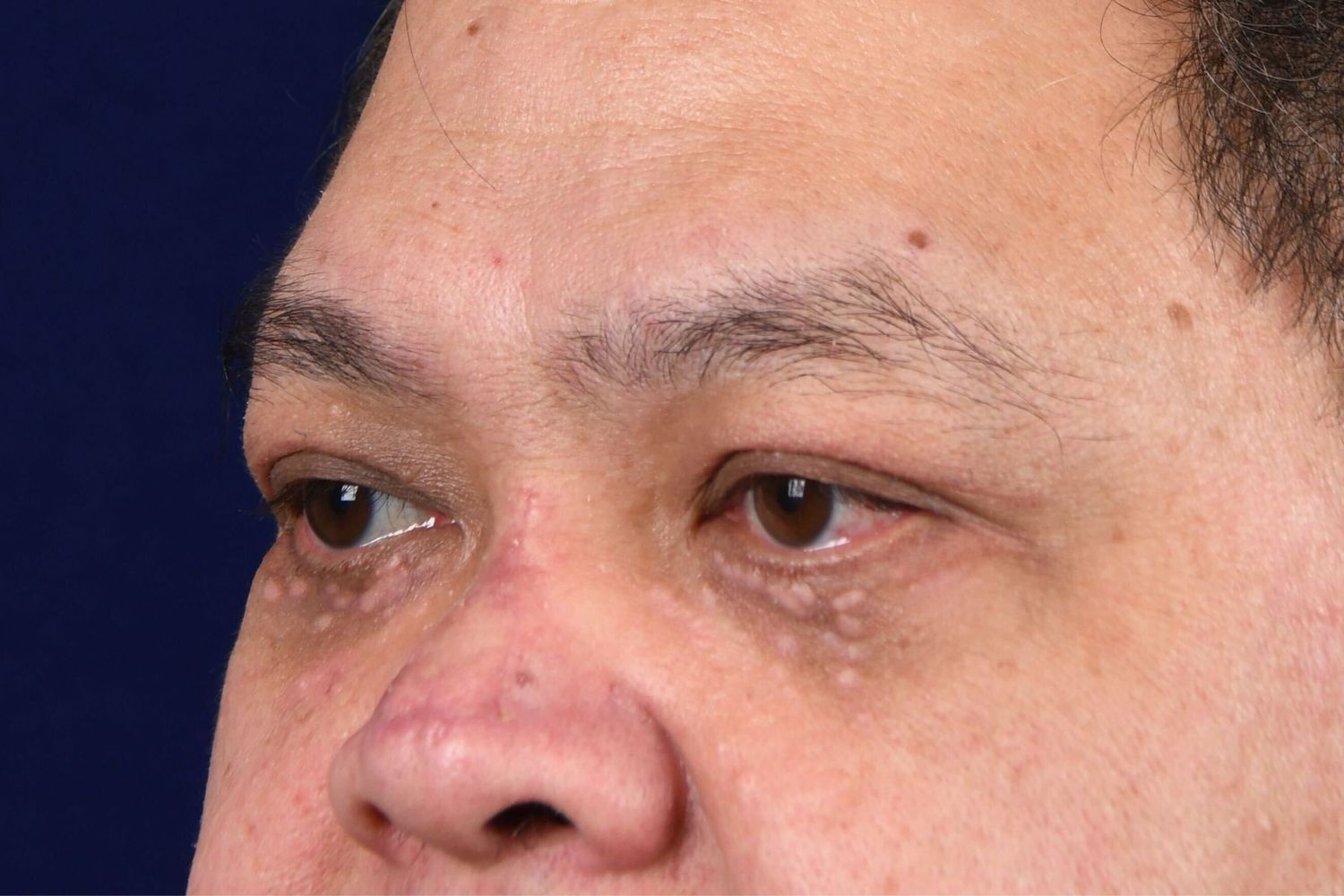 Lower Blepharoplasty Before & After
