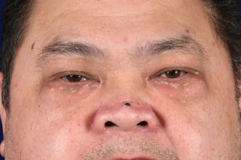 Lower Blepharoplasty Before & After