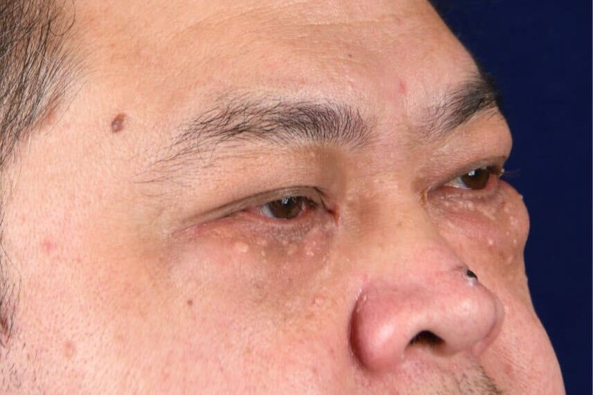 Lower Blepharoplasty Before & After