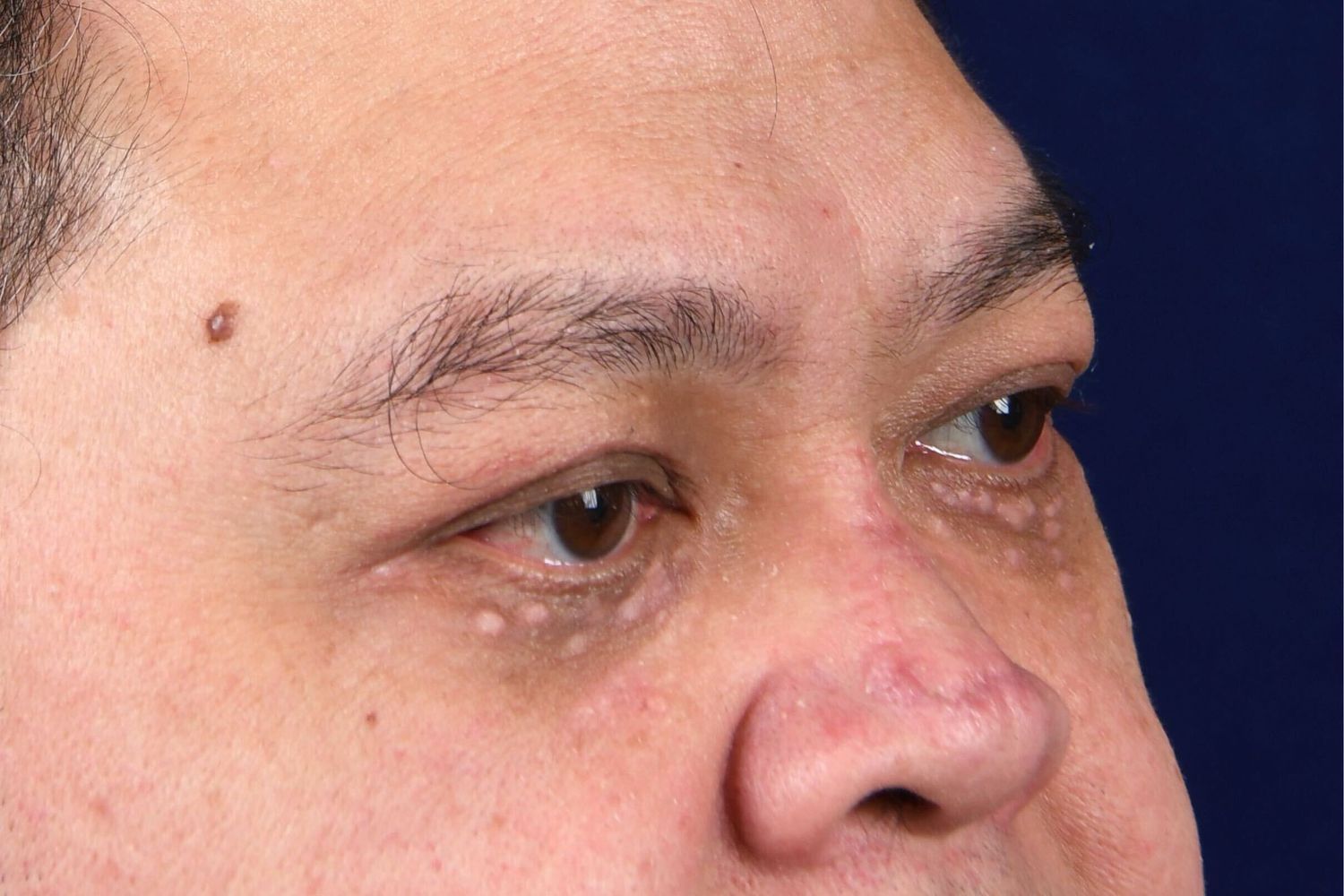 Lower Blepharoplasty Before & After