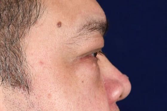 Lower Blepharoplasty Before & After