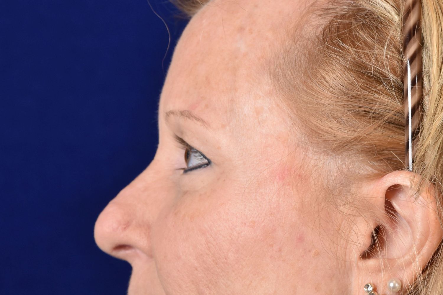 Upper Blepharoplasty Before & After