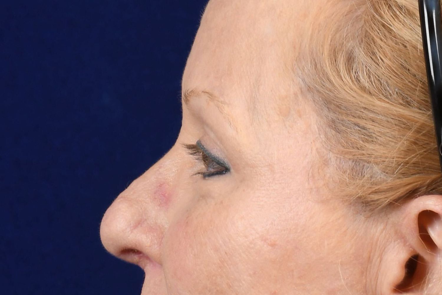 Upper Blepharoplasty Before & After