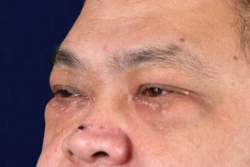 Upper Blepharoplasty Before & After