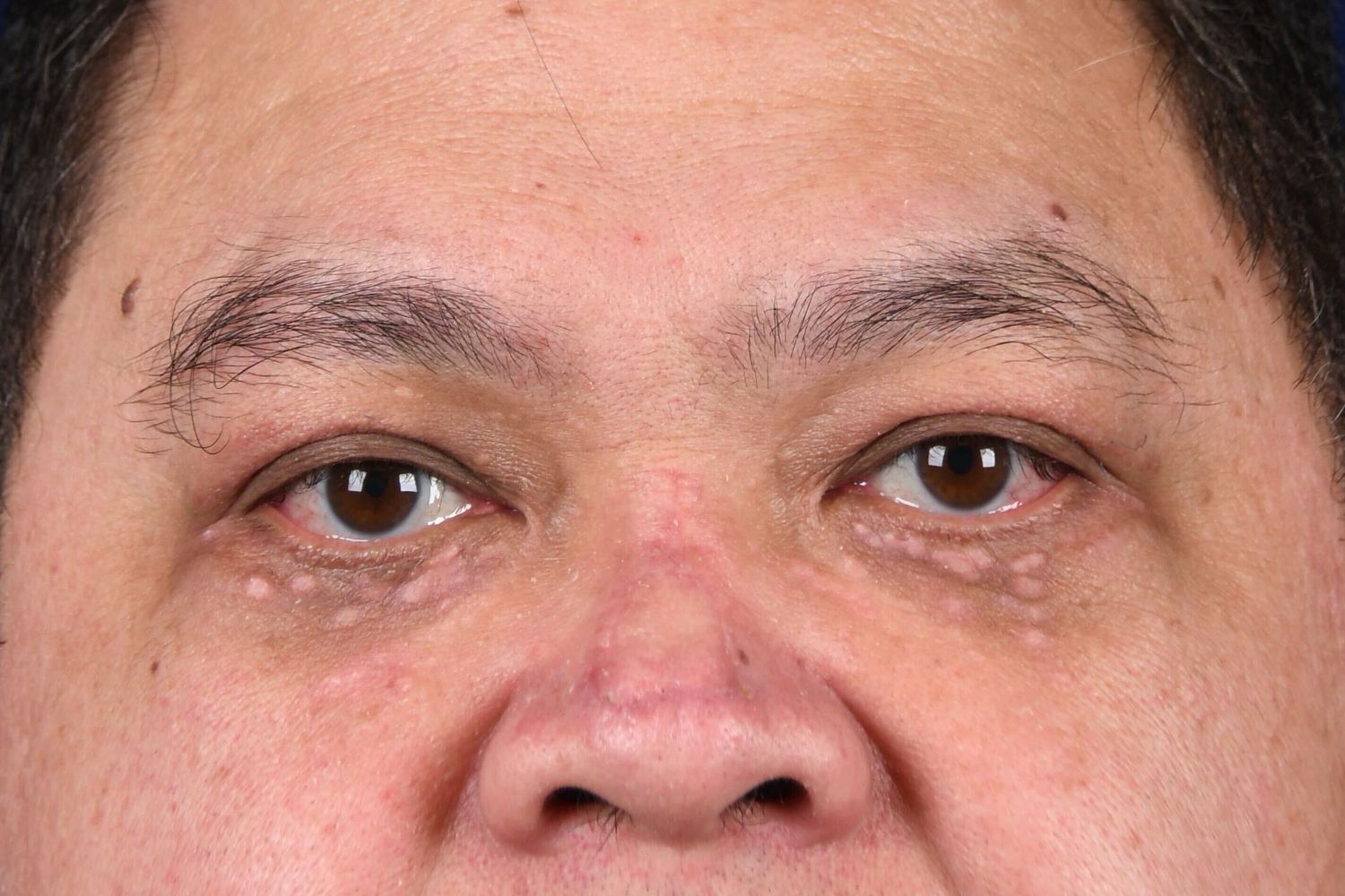 Upper Blepharoplasty Before & After