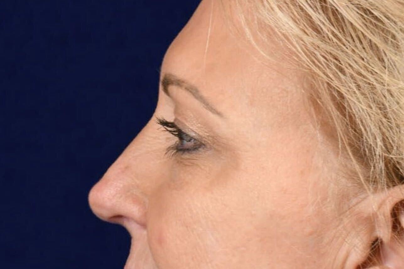 Upper Blepharoplasty Before & After