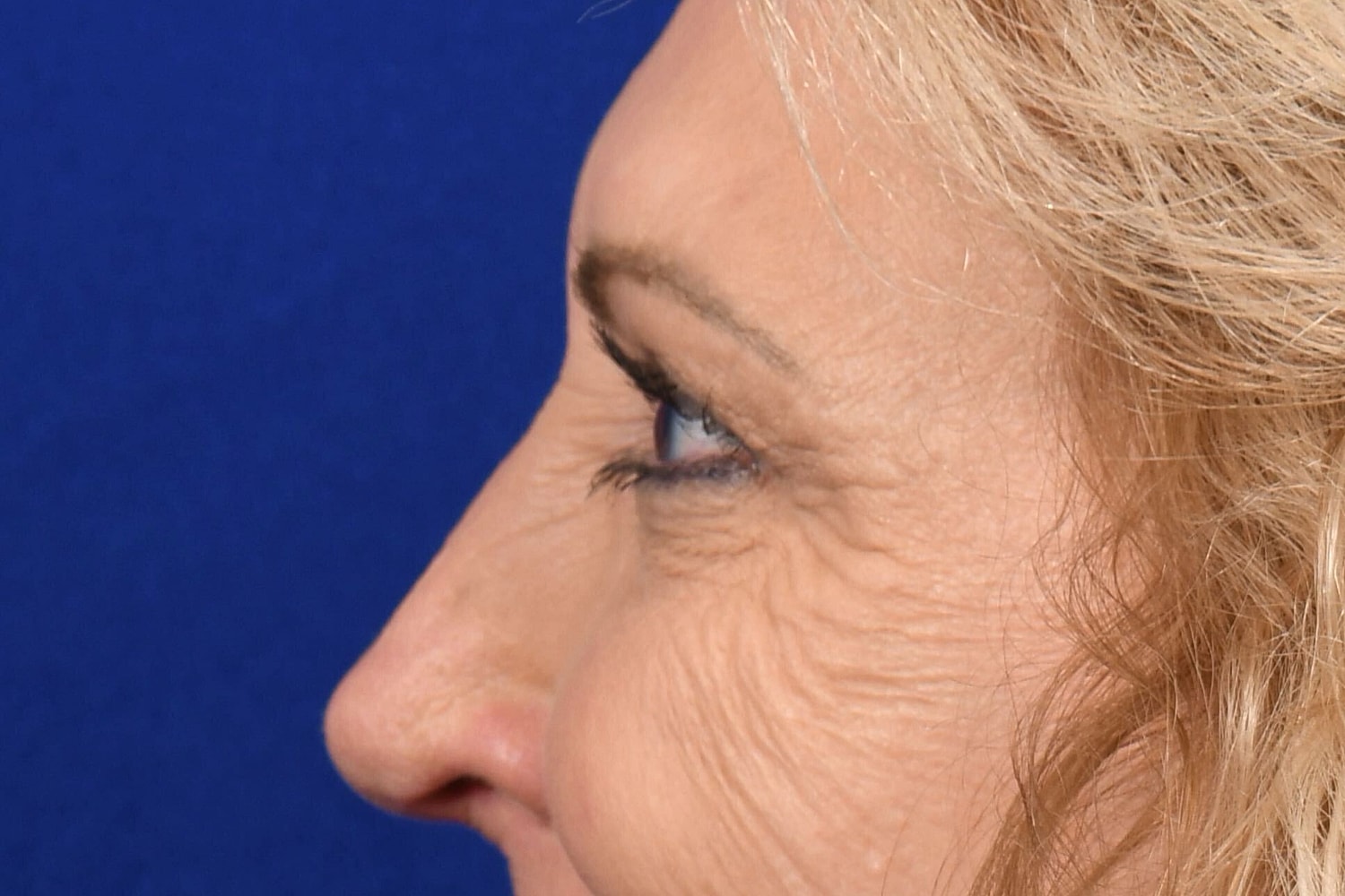 Upper Blepharoplasty Before & After