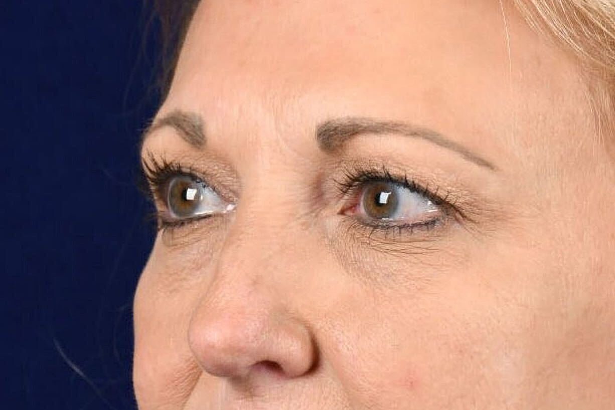 Upper Blepharoplasty Before & After