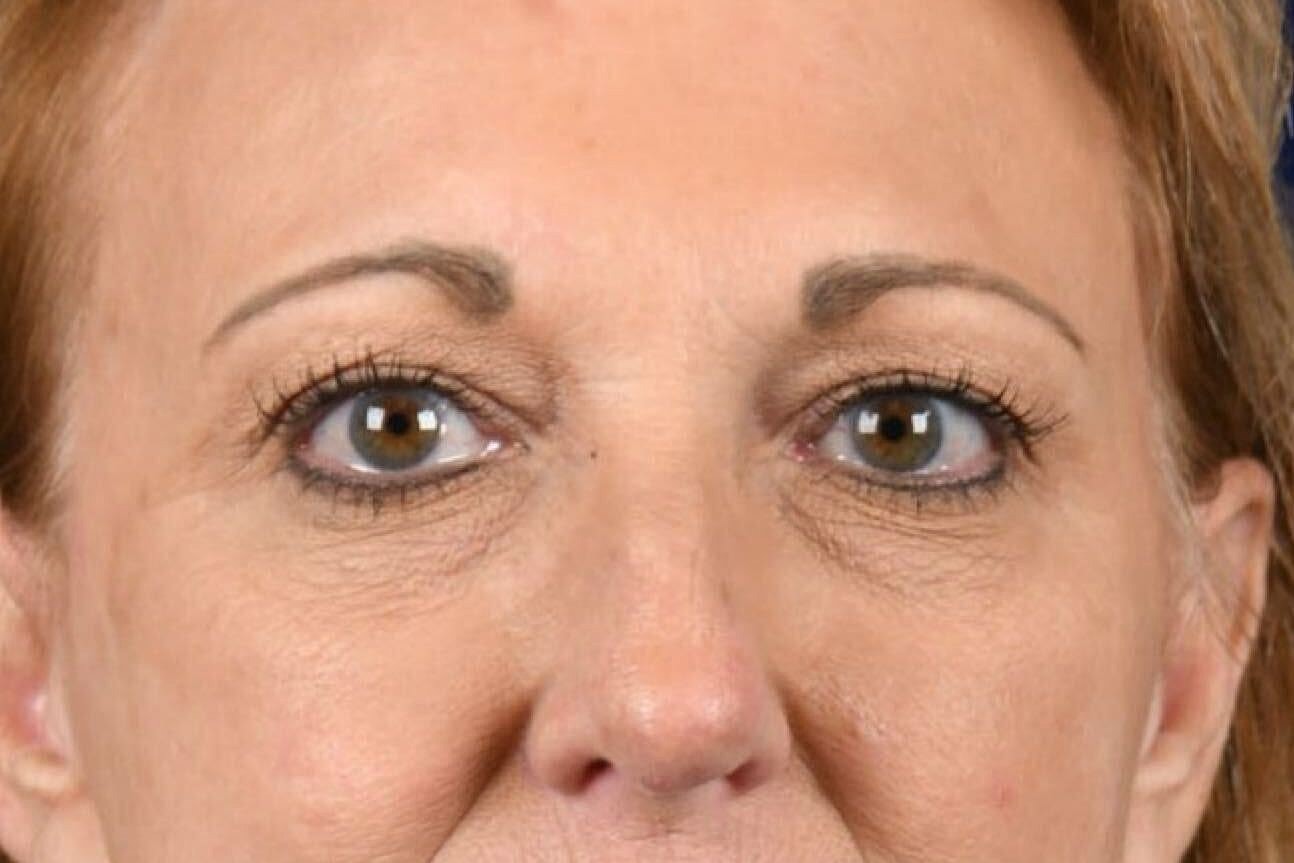 Upper Blepharoplasty Before & After