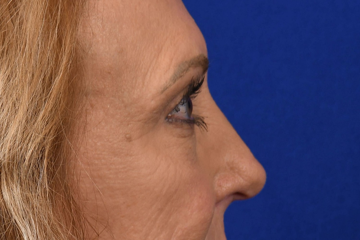 Upper Blepharoplasty Before & After