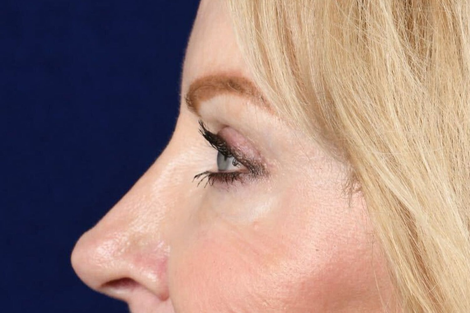 Upper Blepharoplasty Before & After