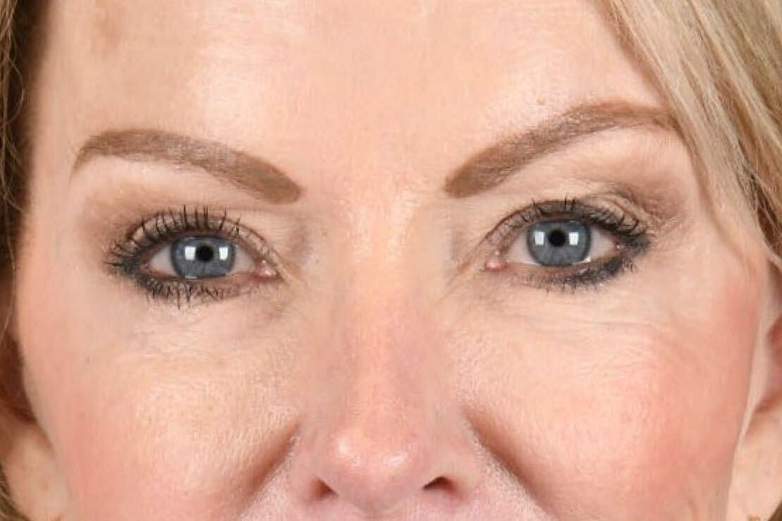 Upper Blepharoplasty Before & After