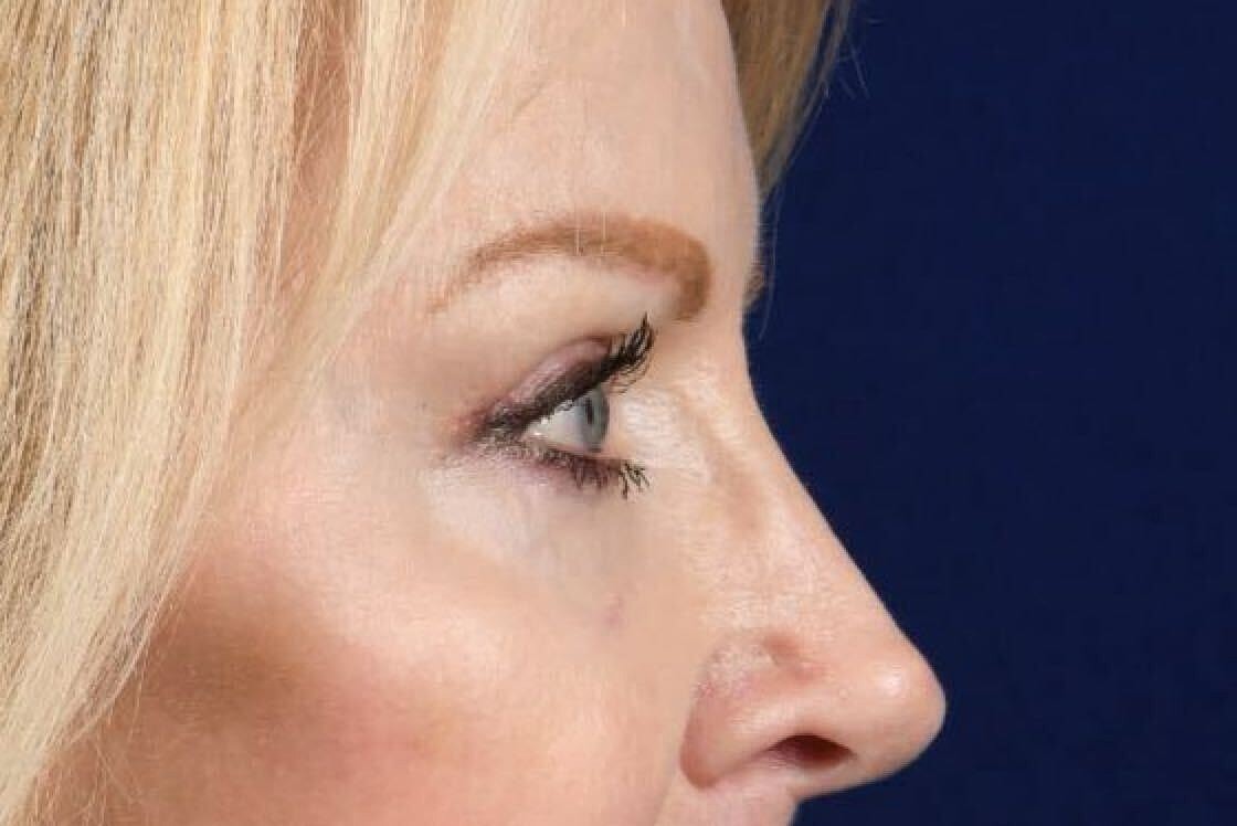 Upper Blepharoplasty Before & After