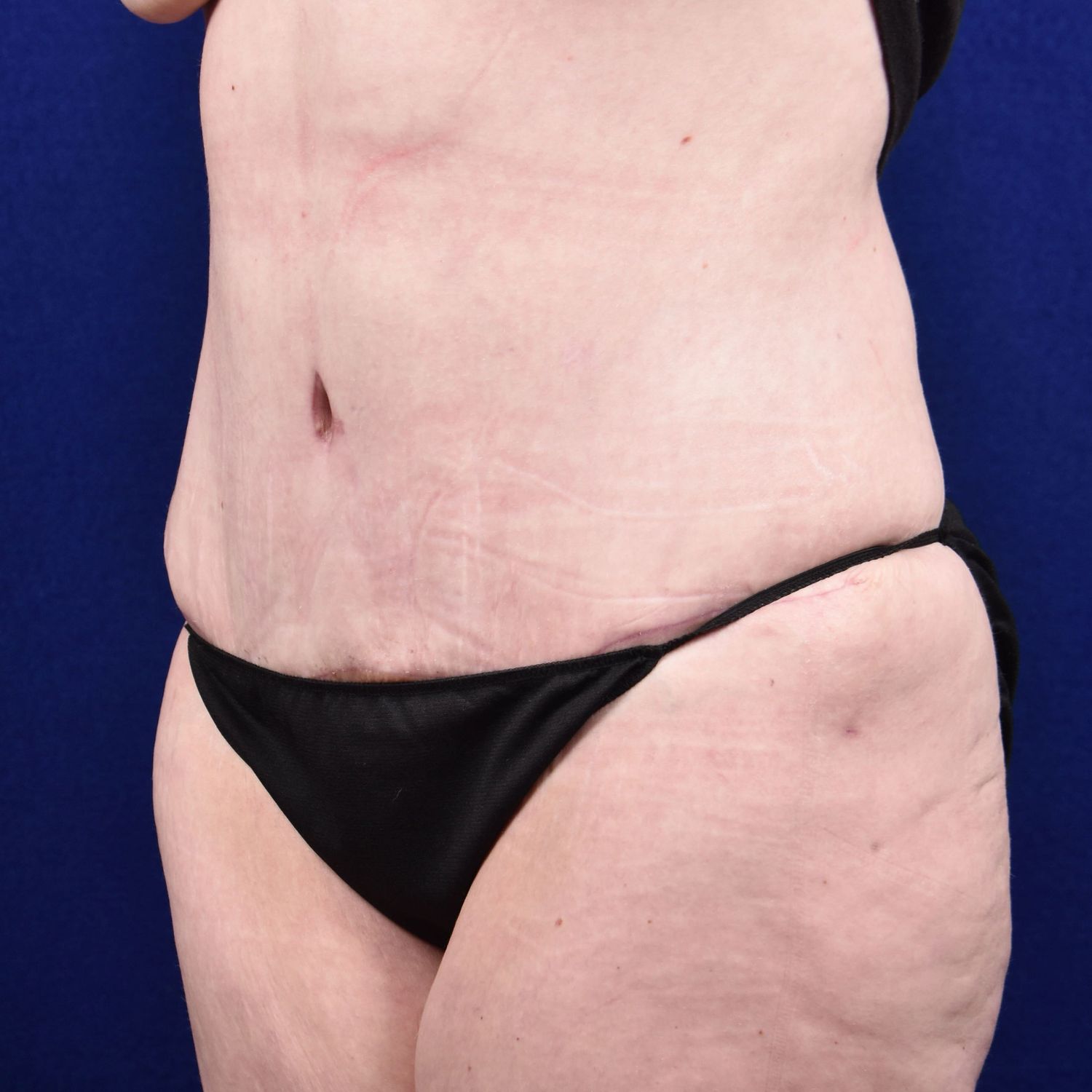 Abdominoplasty Lipo Before & After
