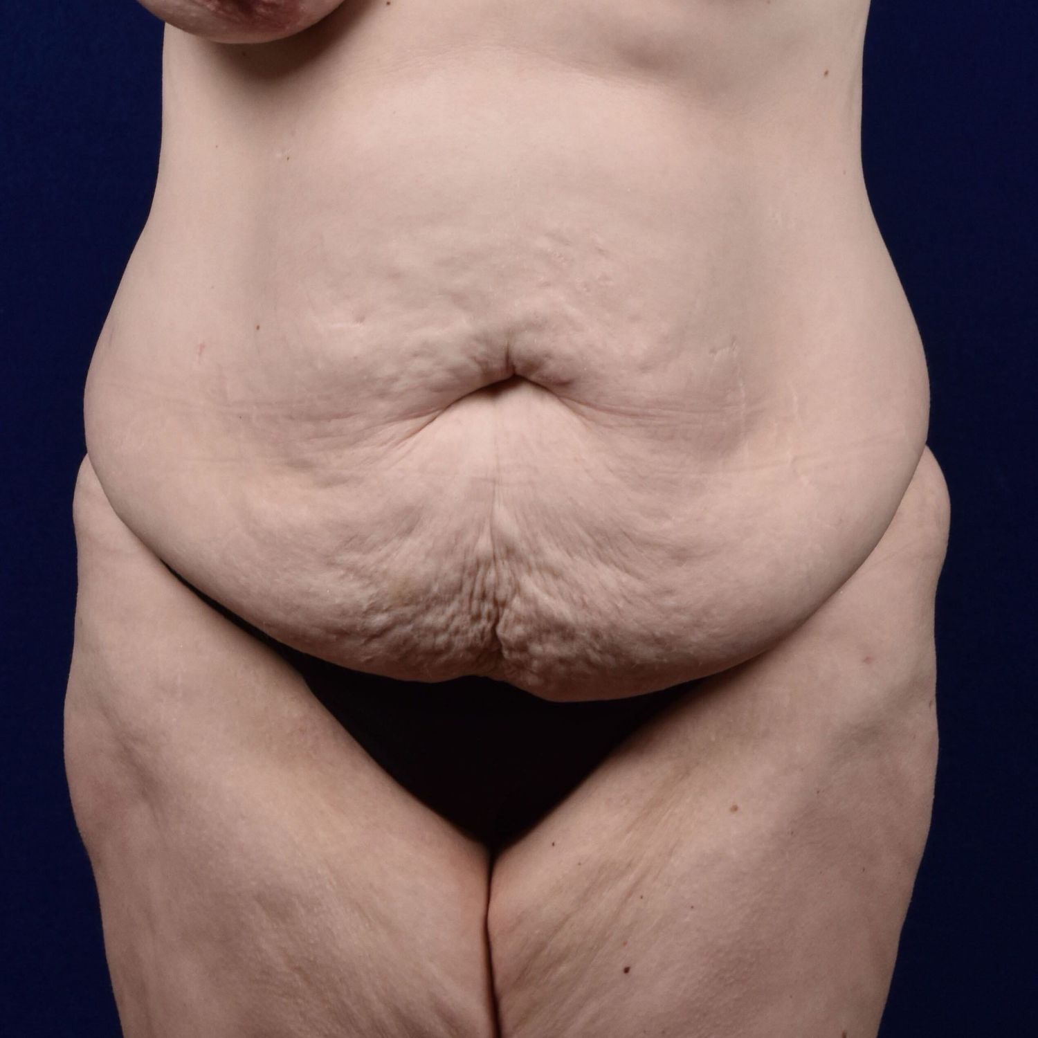 Abdominoplasty Lipo Before & After