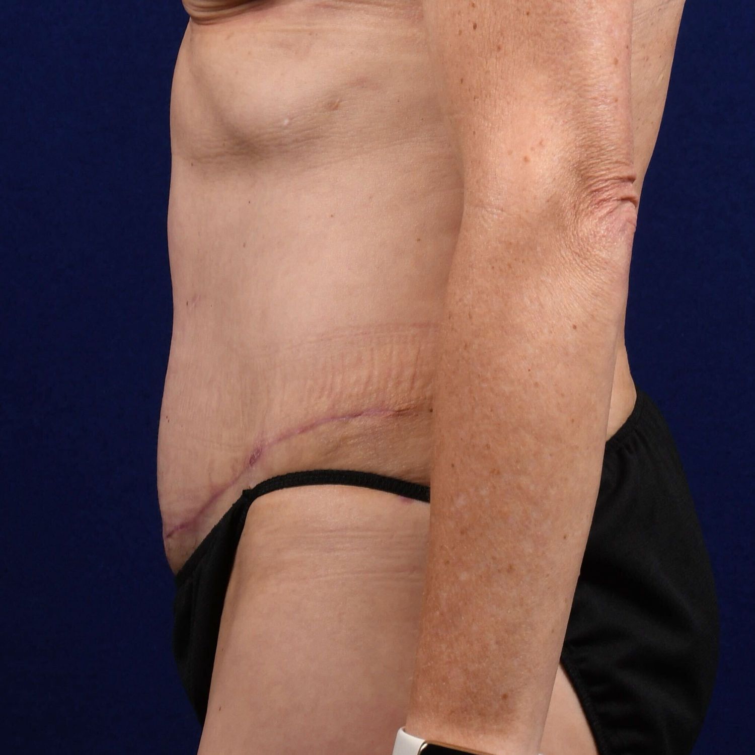 Abdominoplasty Lipo Before & After