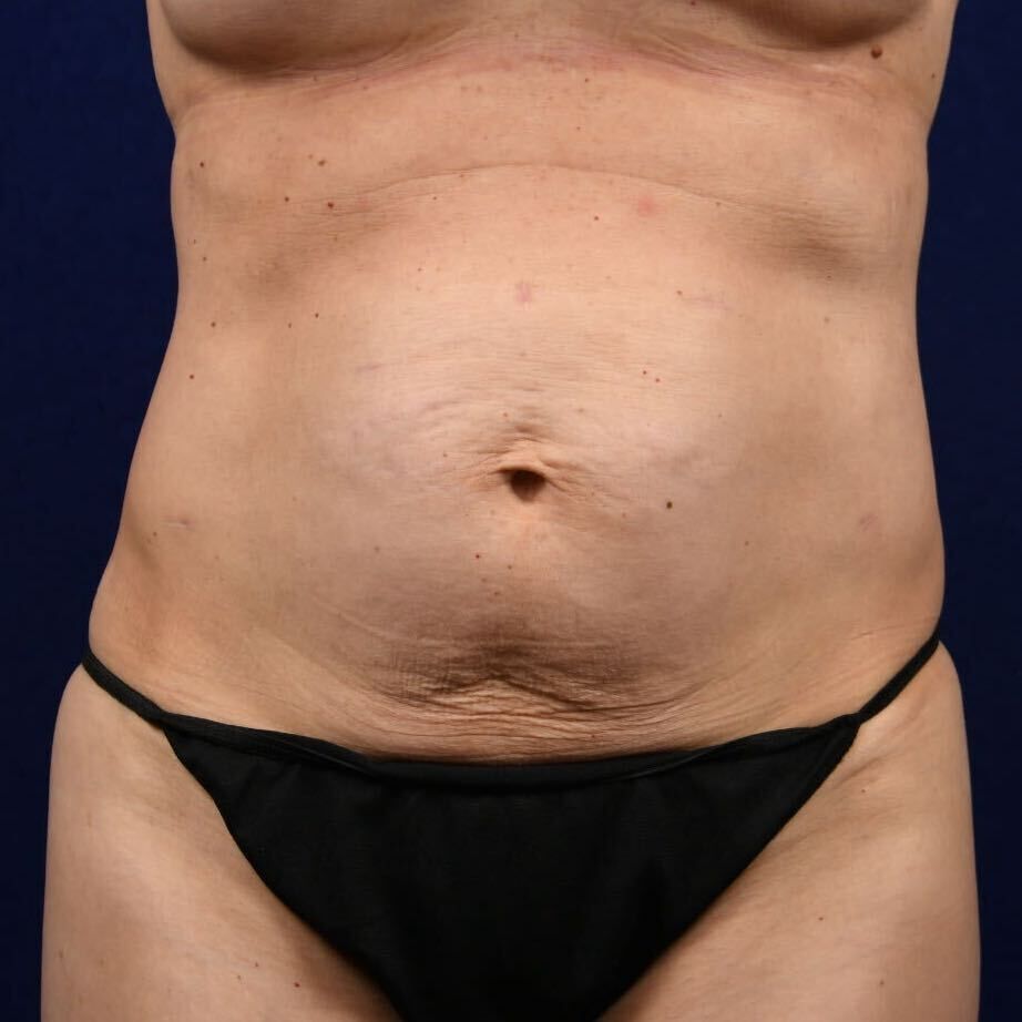 Abdominoplasty Lipo Before & After