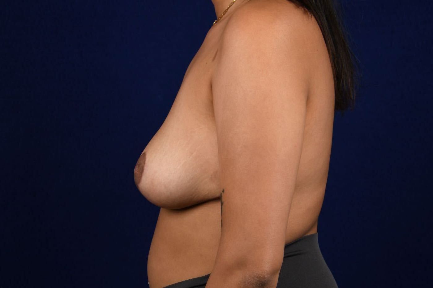 Breast Lift Reduction Before & After