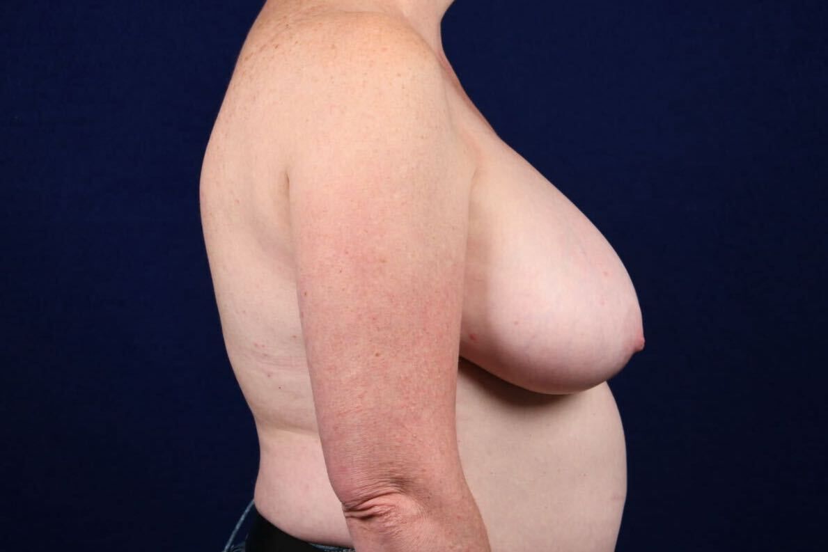 Breast Lift Reduction Before & After