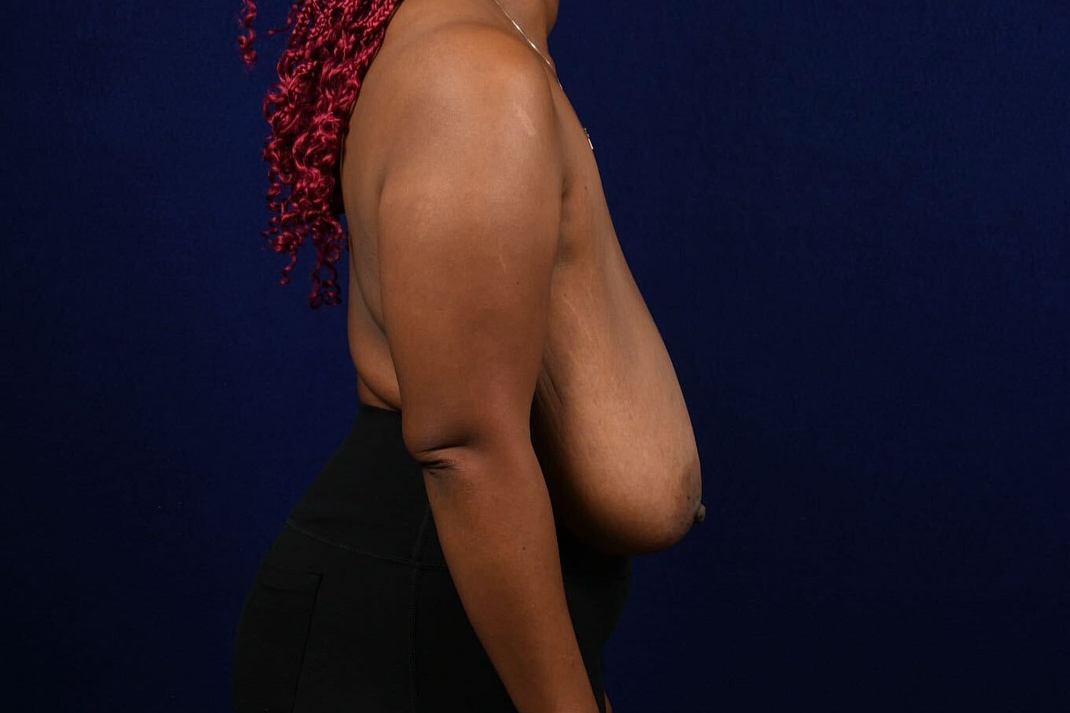 Breast Lift / Reduction Before & After