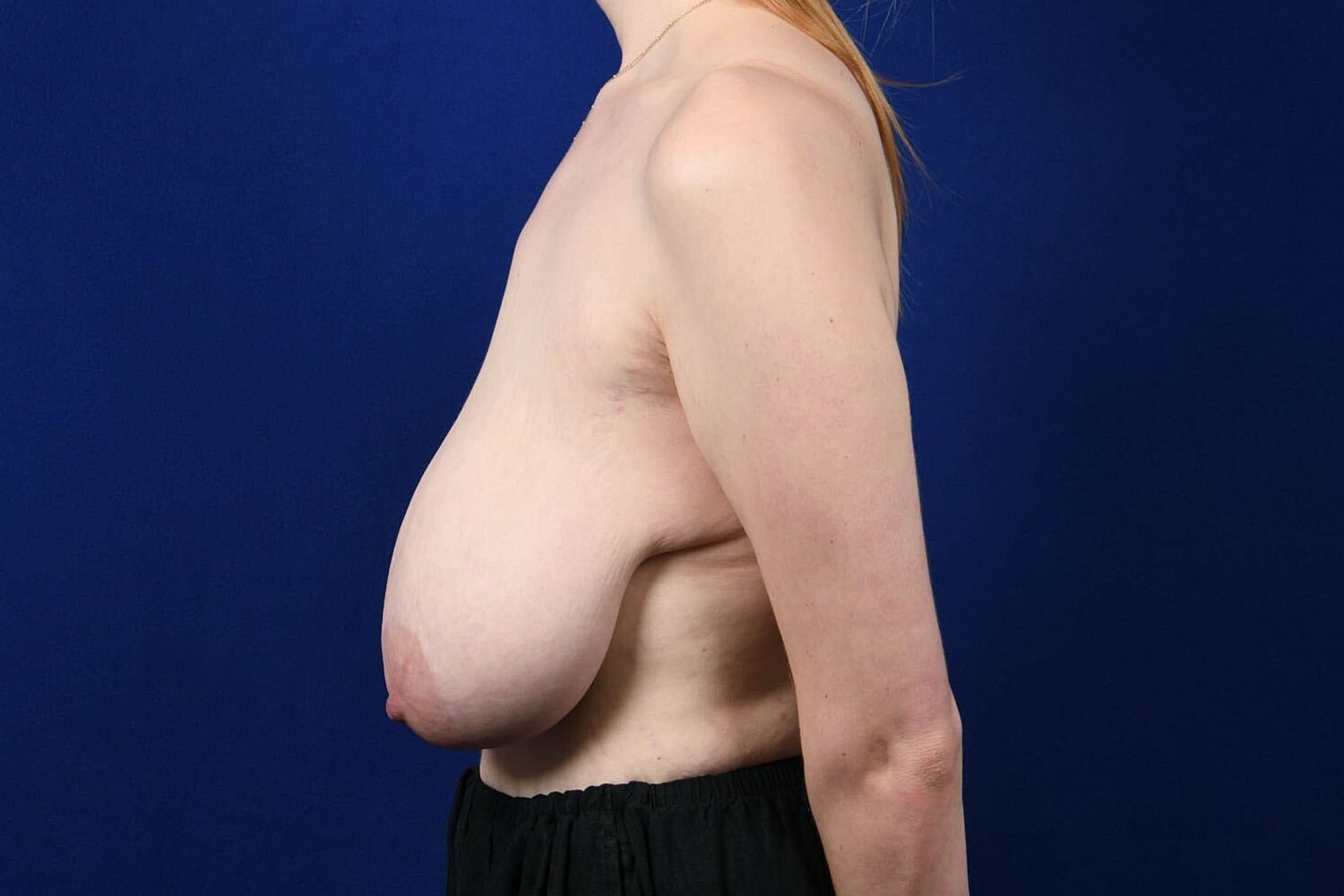 Breast Lift / Reduction Before & After