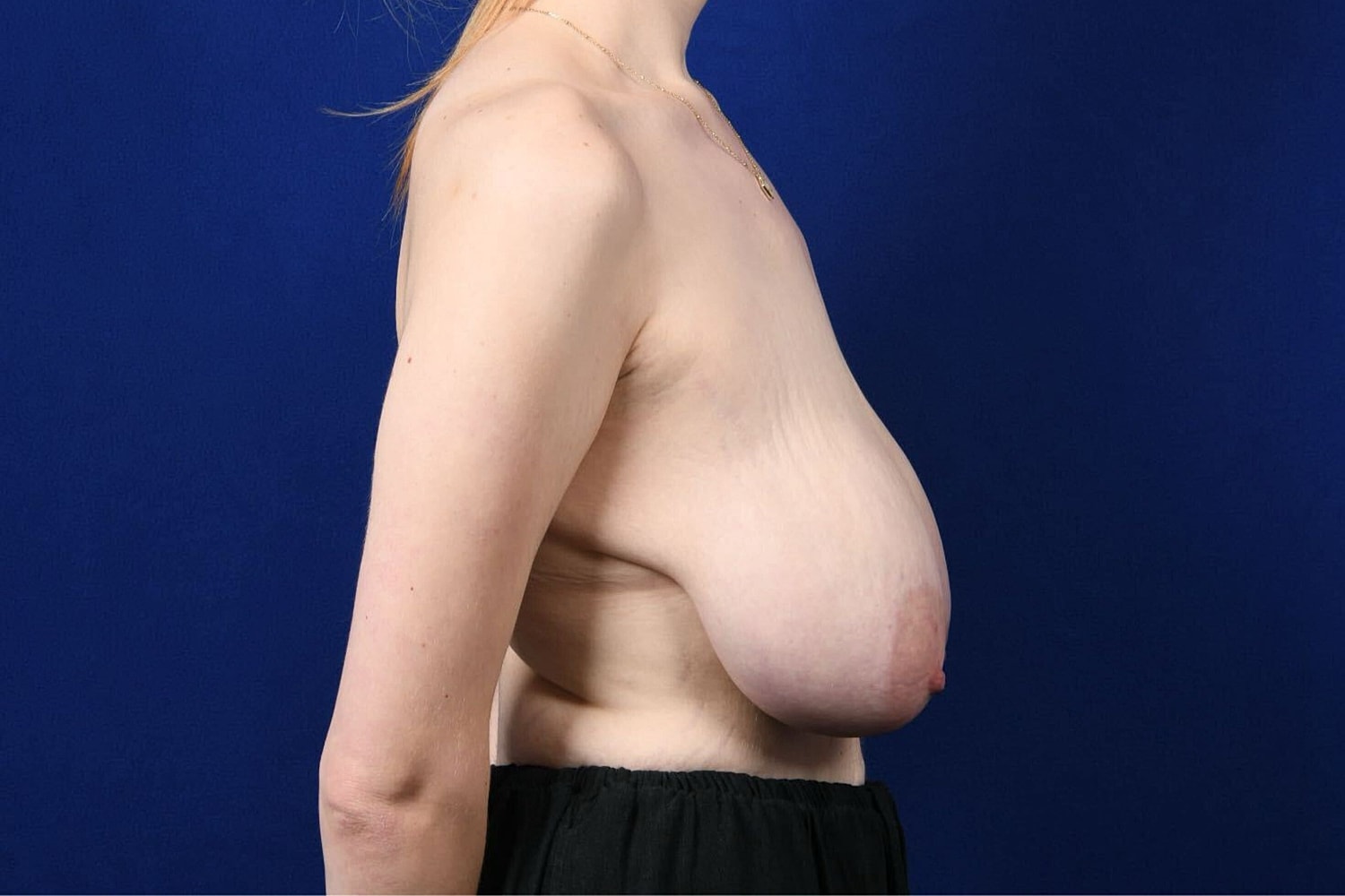 Breast Lift / Reduction Before & After