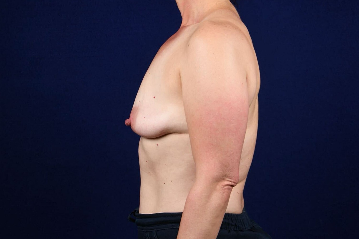 Breast Augmentation With Lift Before & After