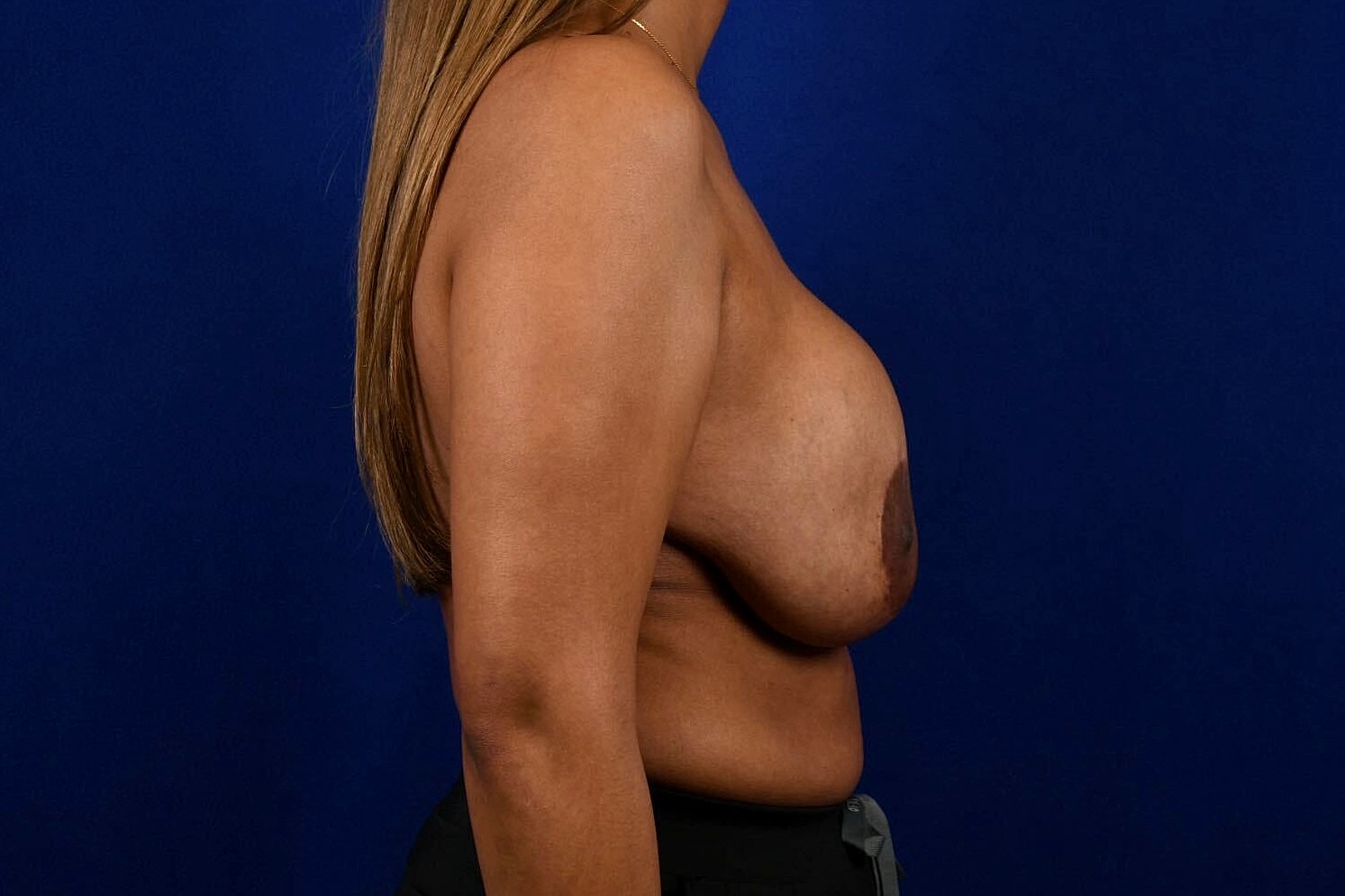 Breast Augmentation With Lift Before & After