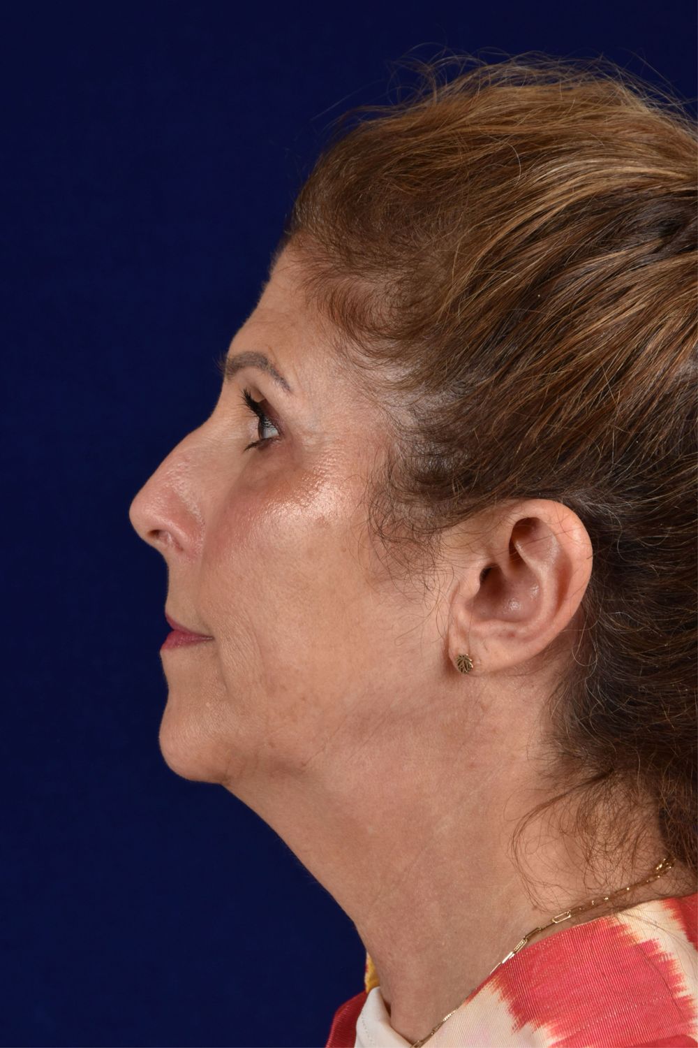 Facial Rejuvenation Before & After