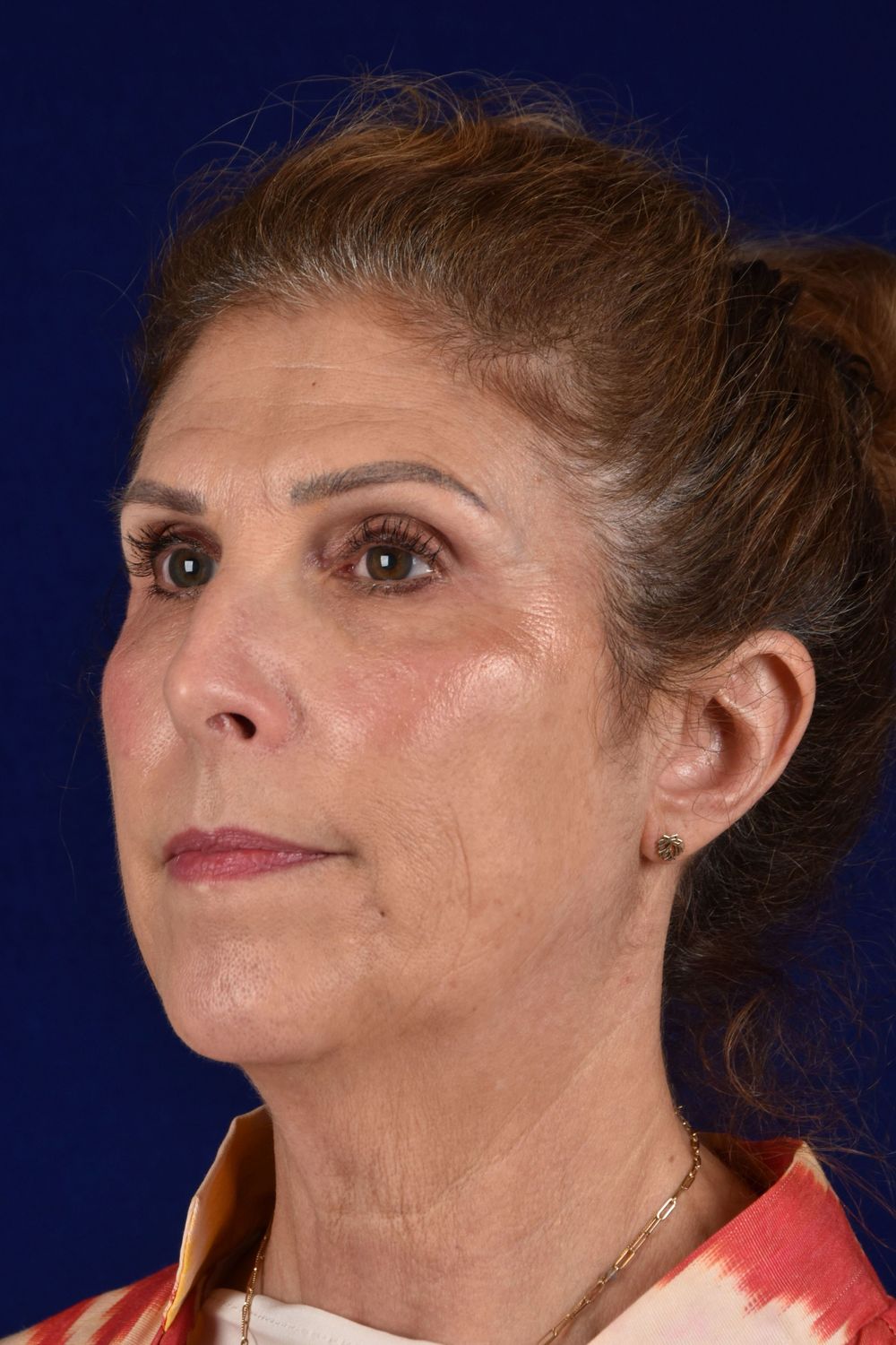 Facial Rejuvenation Before & After