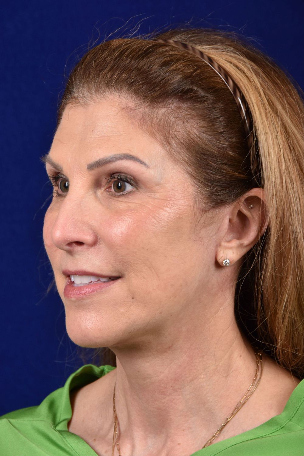 Facial Rejuvenation Before & After