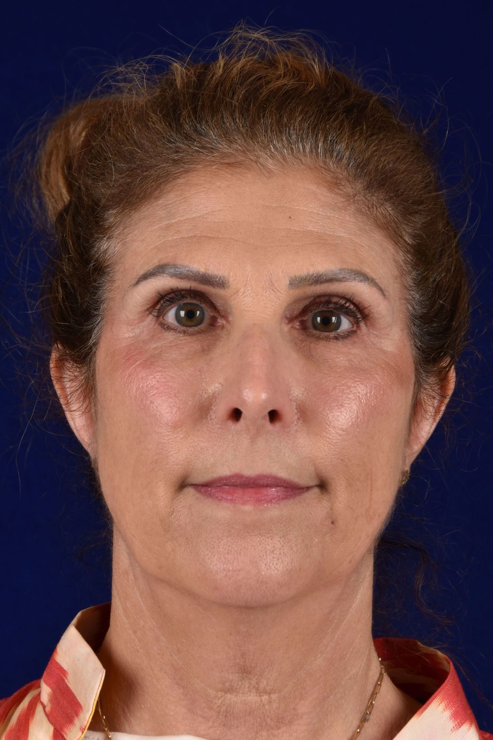 Facial Rejuvenation Before & After