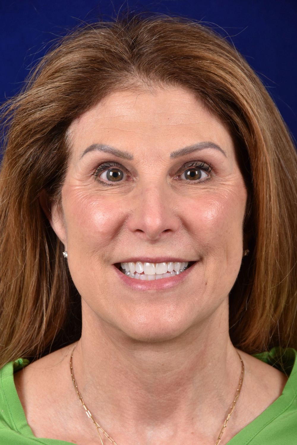 Facial Rejuvenation Before & After