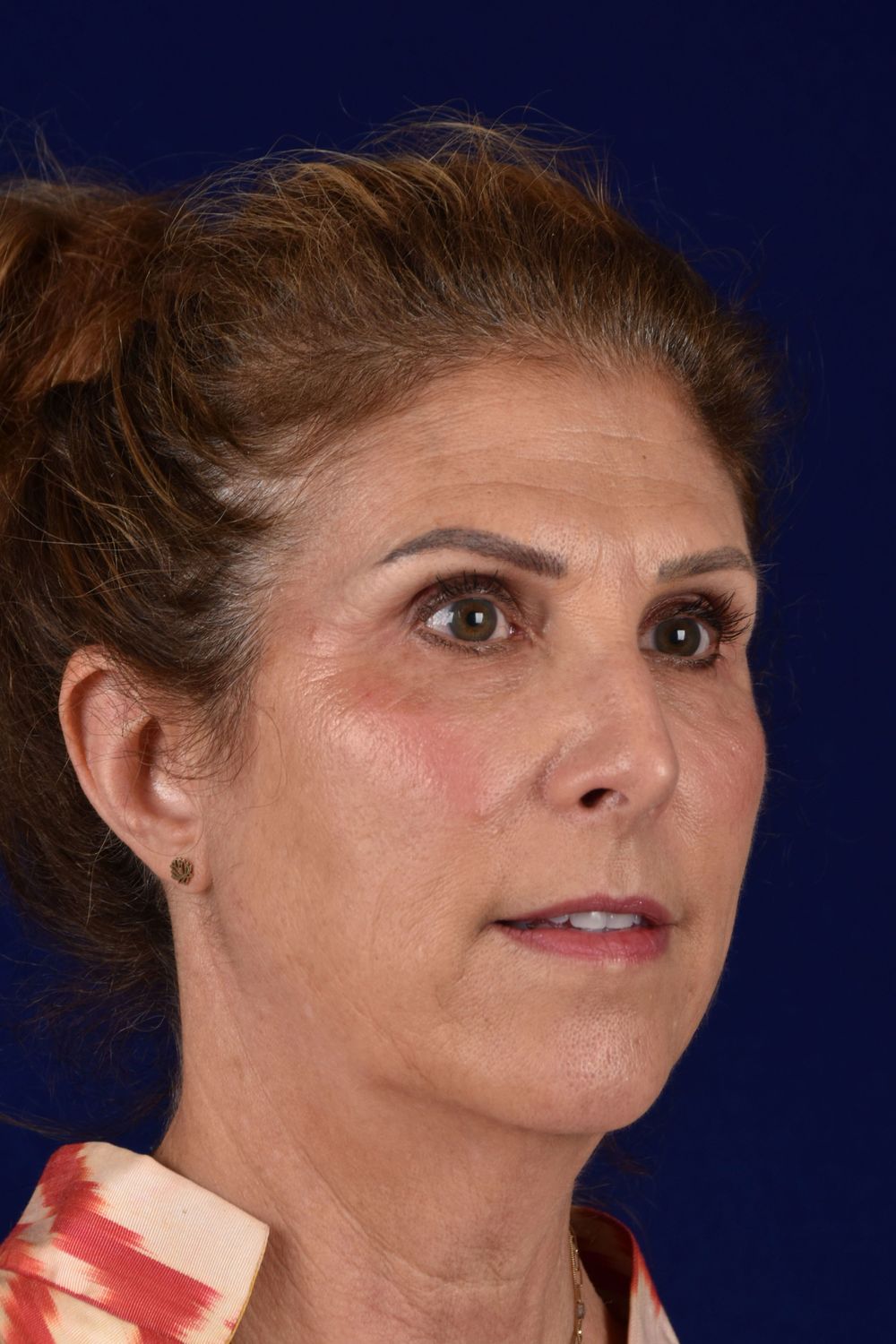 Facial Rejuvenation Before & After