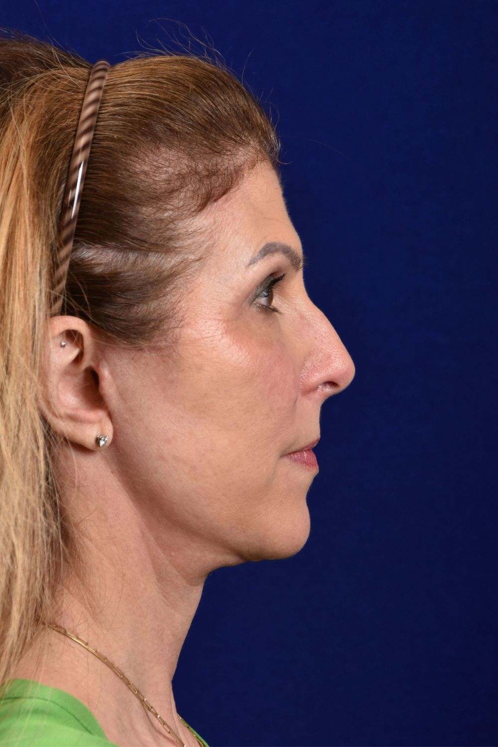 Facial Rejuvenation Before & After