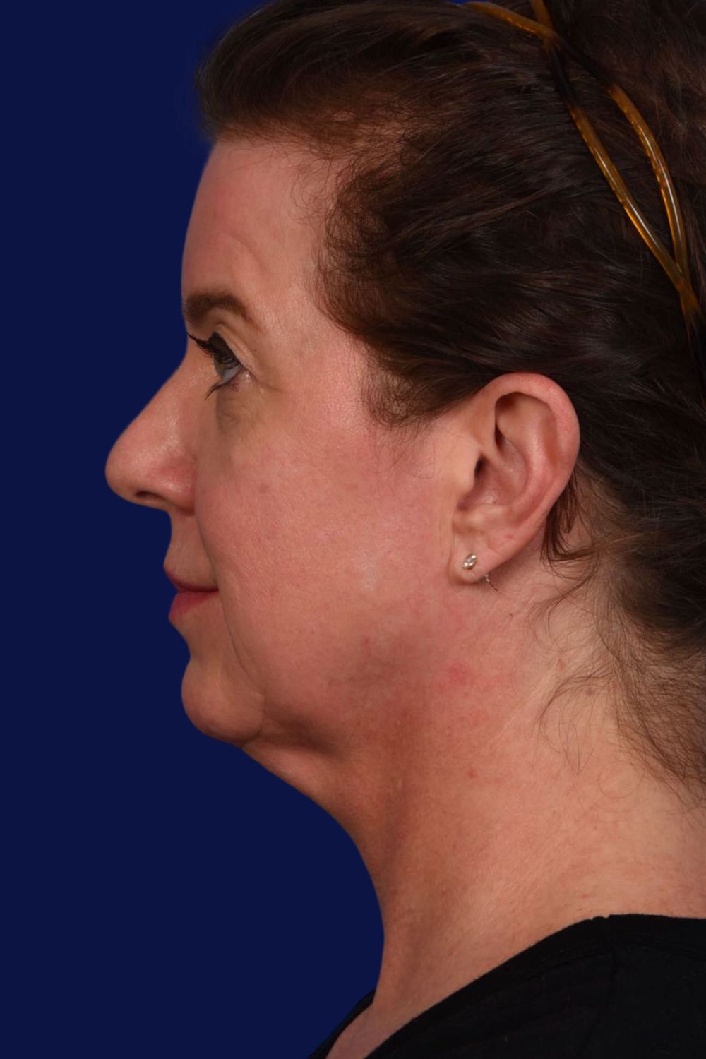 Facial Rejuvenation Before & After