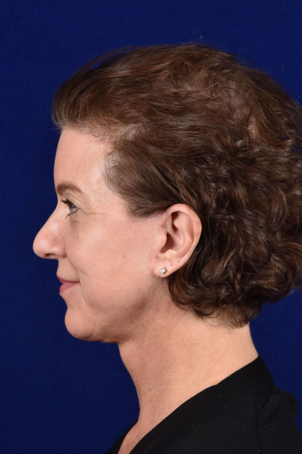 Facial Rejuvenation Before & After