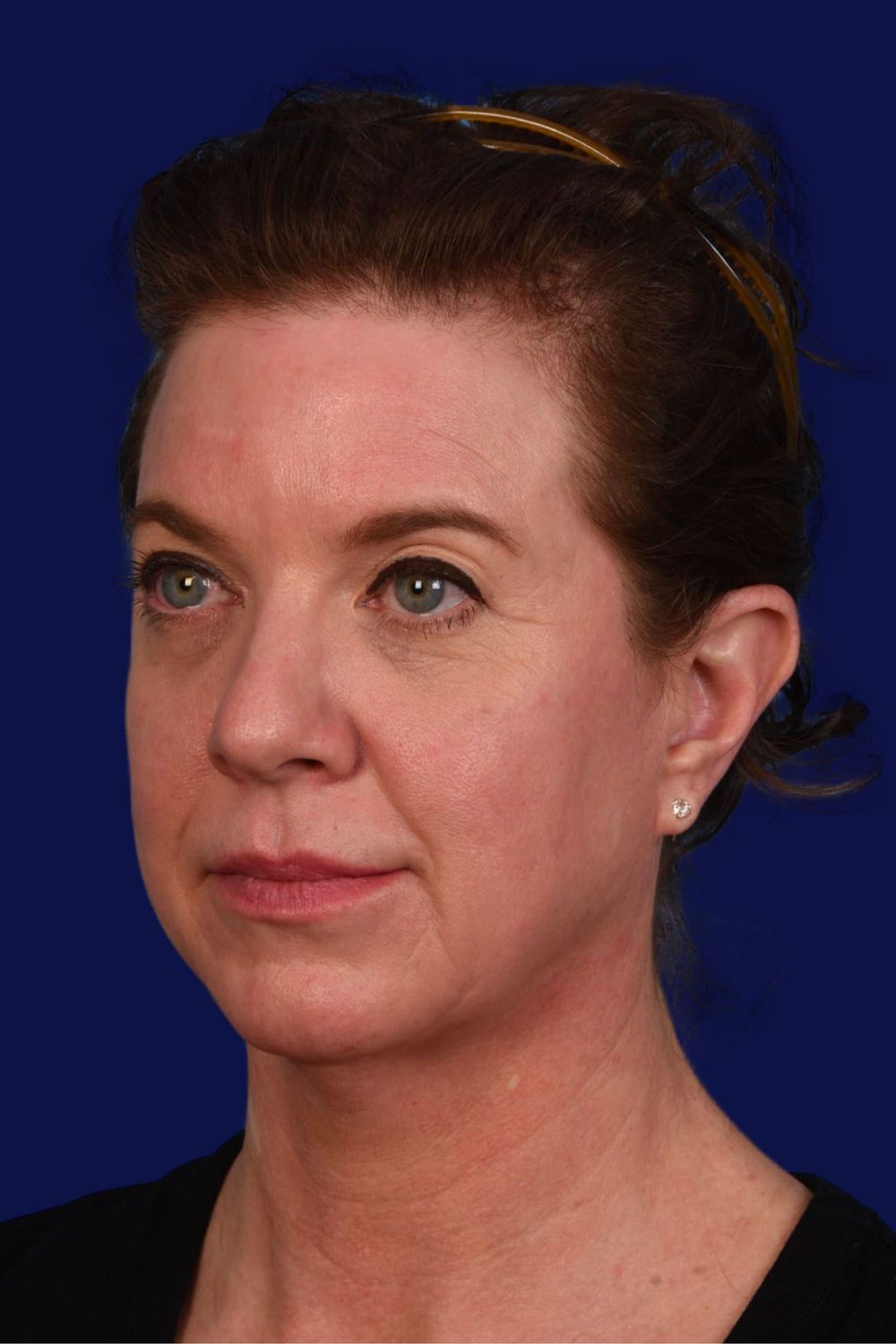 Facial Rejuvenation Before & After