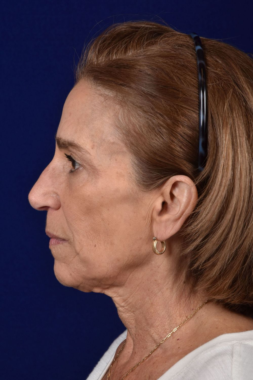 Facial Rejuvenation Before & After