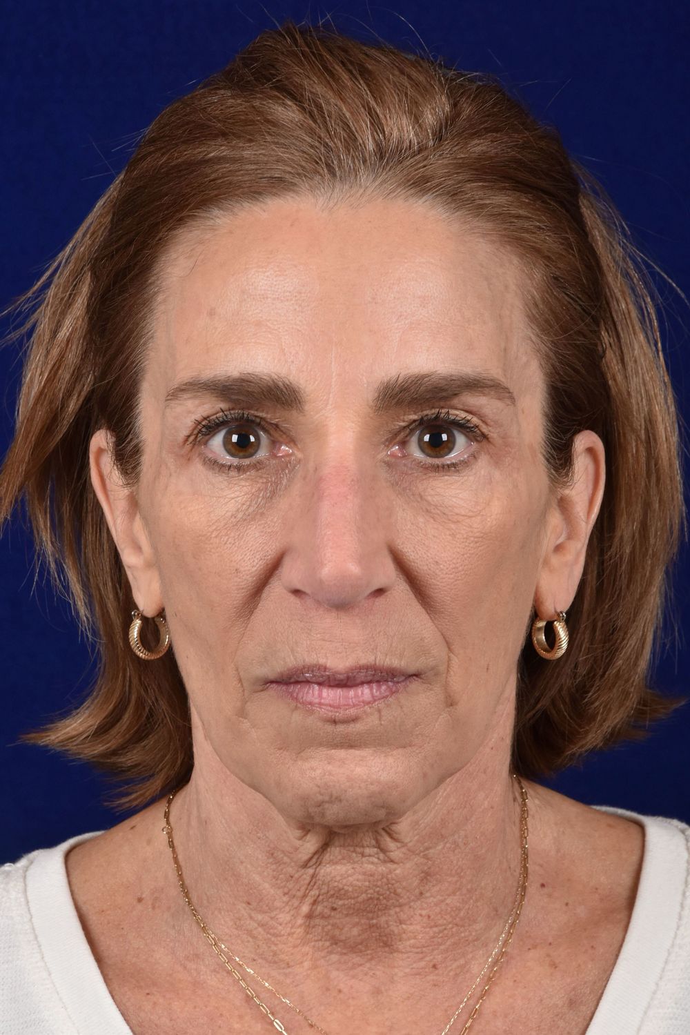 Facial Rejuvenation Before & After