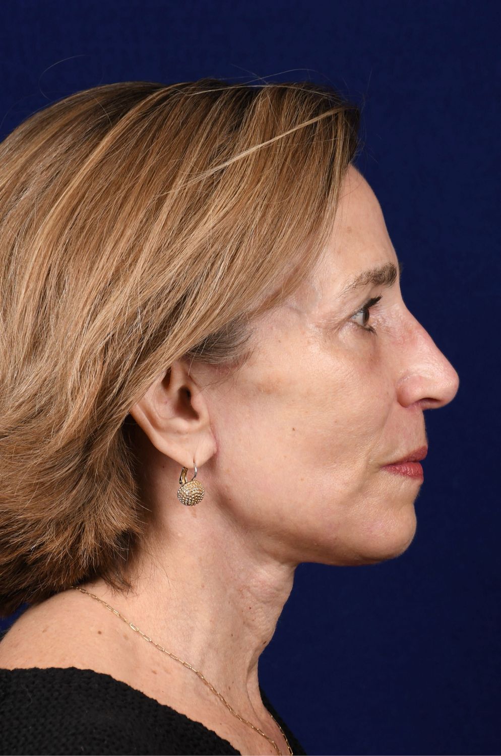 Facial Rejuvenation Before & After