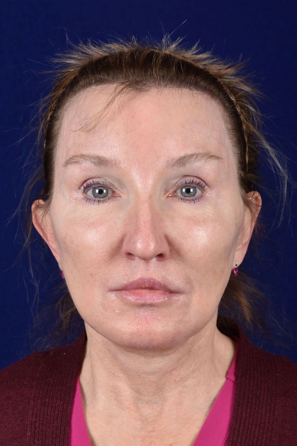 Facial Rejuvenation Before & After