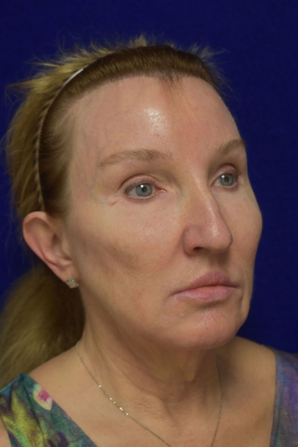 Facial Rejuvenation Before & After