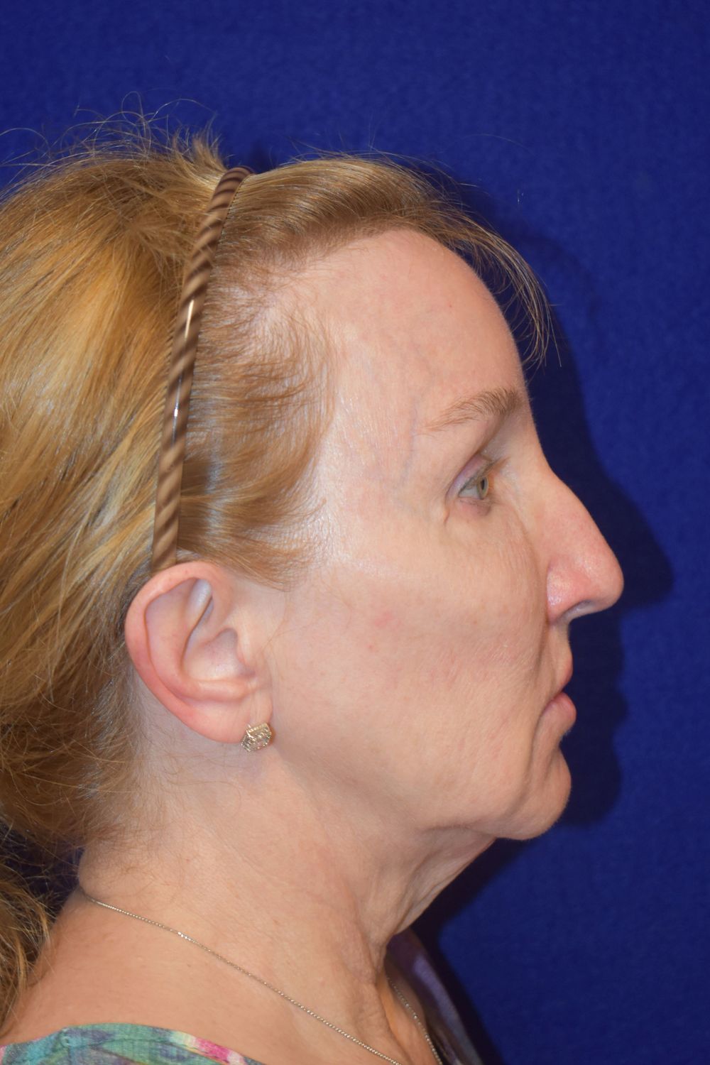 Facial Rejuvenation Before & After