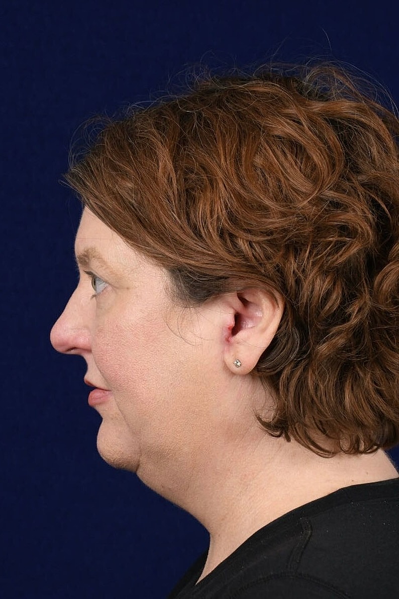 Facial Rejuvenation Before & After