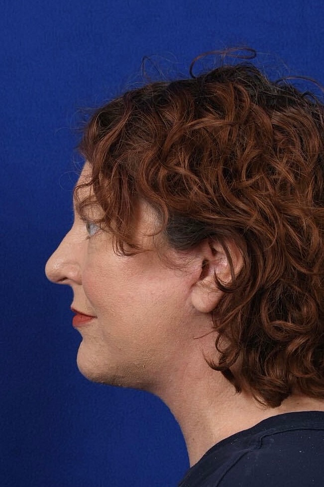 Facial Rejuvenation Before & After