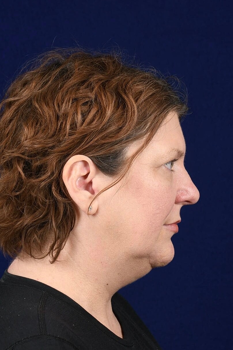 Facial Rejuvenation Before & After