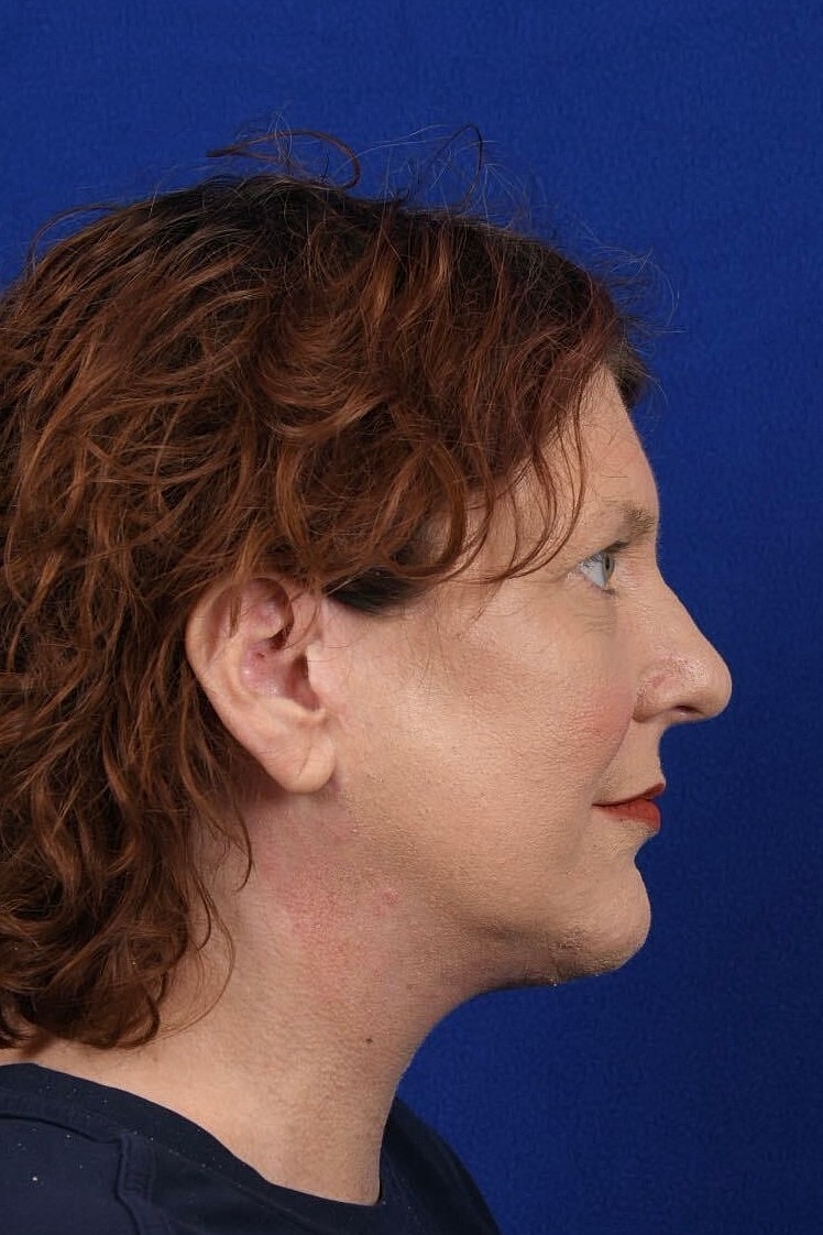 Facial Rejuvenation Before & After