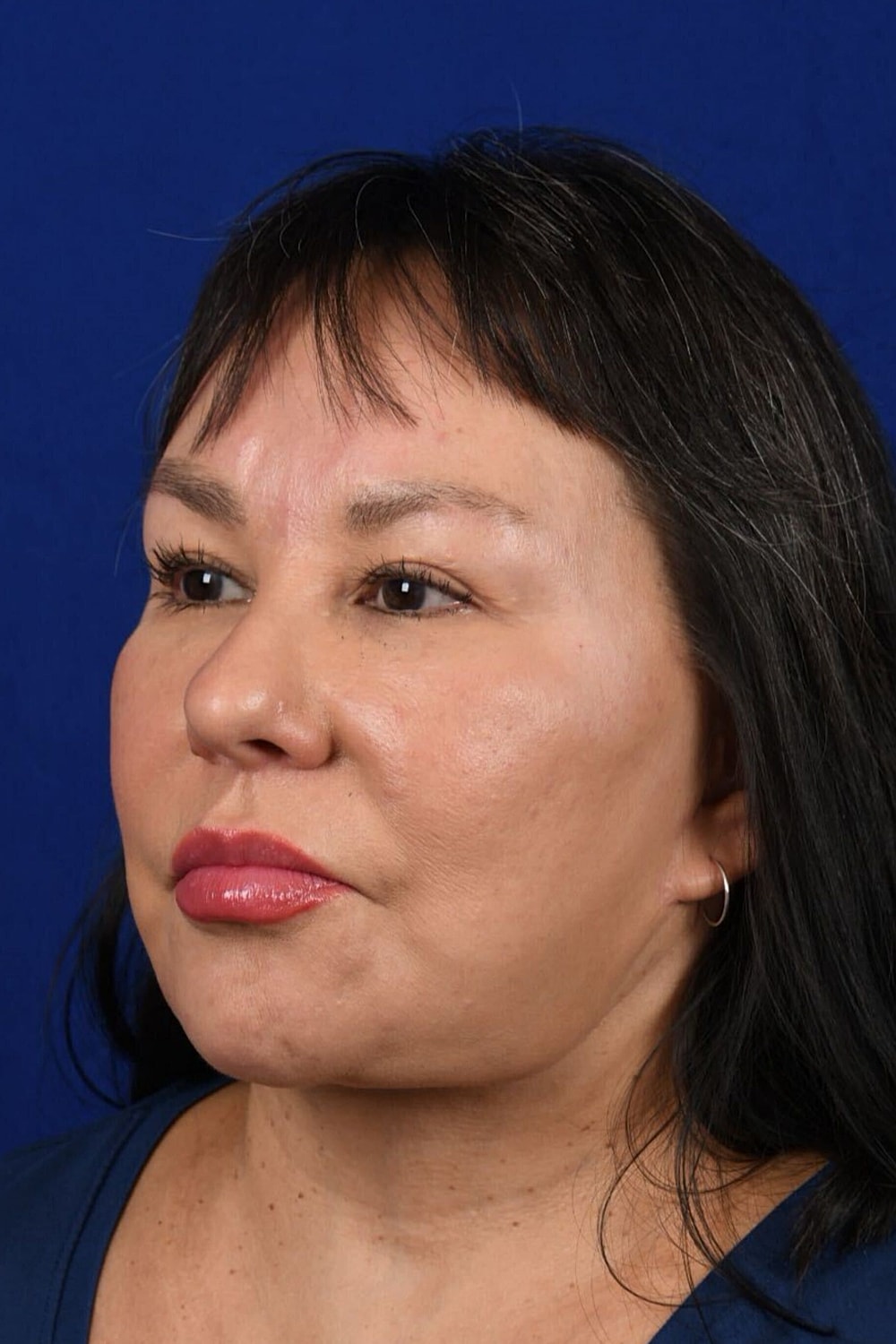 Facial Rejuvenation Before & After